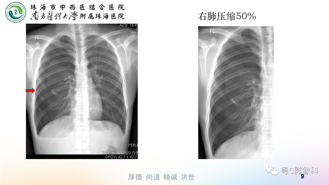 氣胸胸腔積液肋骨骨折影像表現