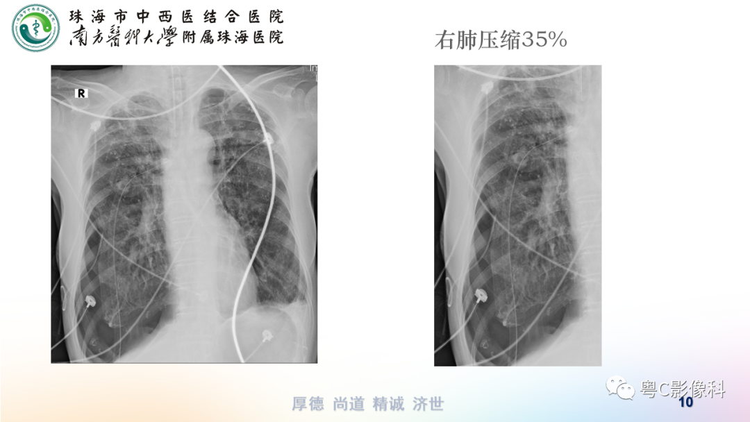 氣胸胸腔積液肋骨骨折影像表現