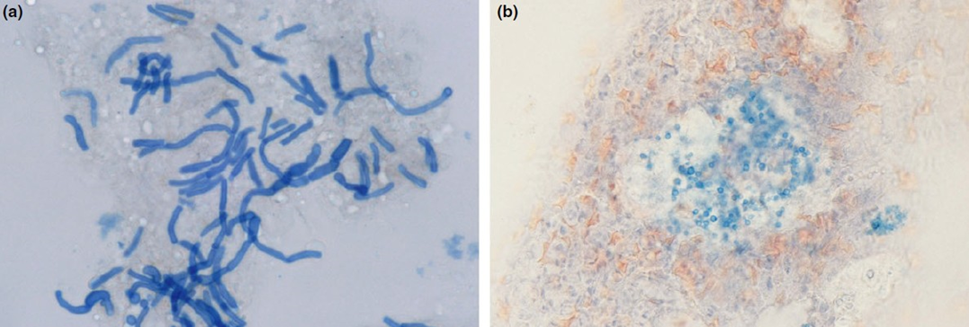临床盘点这4种马拉色菌相关皮肤病你都见过吗
