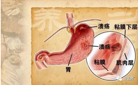 胃溃疡和胃糜烂的区别?