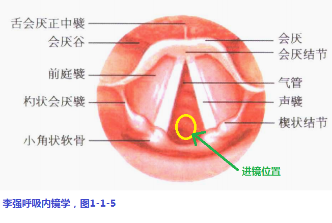 喉镜下声门解剖图图片