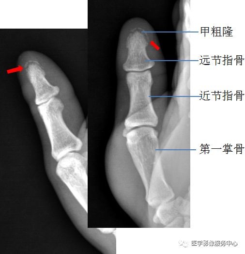 独立值班了 这些骨折你都看出来了吗 附注解 医学界 助力医生临床决策和职业成长