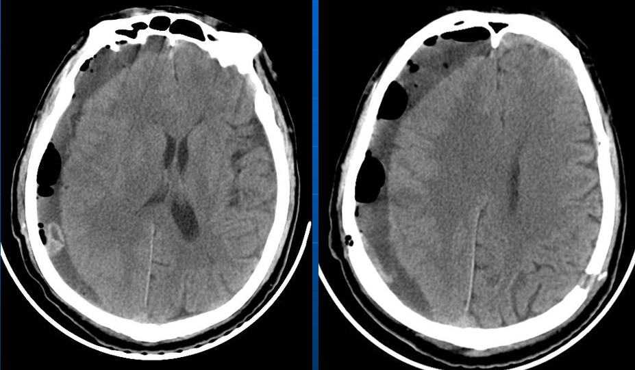 一例慢性硬膜下血腫分享_醫學界-助力醫生臨床決策和職業成長
