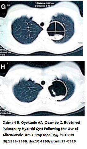肺棘球蚴病图片