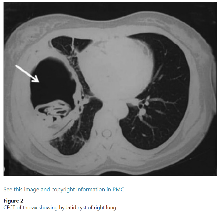 肺包虫囊肿破裂图片图片