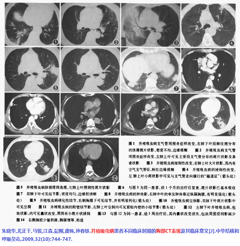 下面这个肺包虫病,寄生虫都裂开了,形成空洞,但是ct表现还是四不像,你
