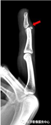 独立值班了这些骨折你都看出来了吗 附注解 医学界 助力医生临床决策和职业成长