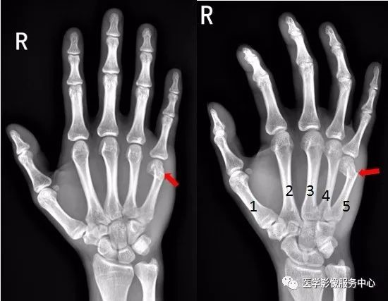 独立值班了这些骨折你都看出来了吗 附注解 医学界 助力医生临床决策和职业成长