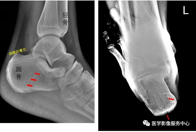 独立值班了这些骨折你都看出来了吗 附注解 医学界 助力医生临床决策和职业成长