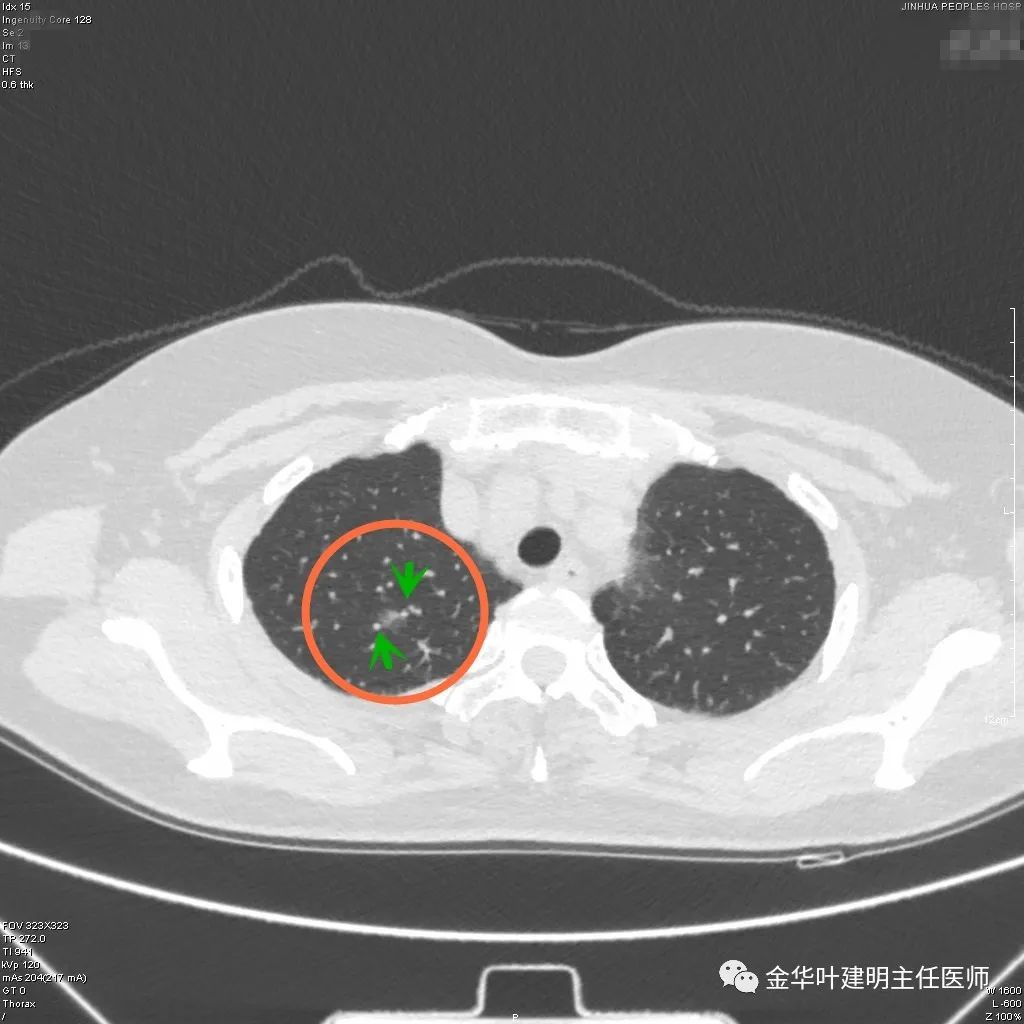 一類特殊的肺磨玻璃結節立馬收藏學習