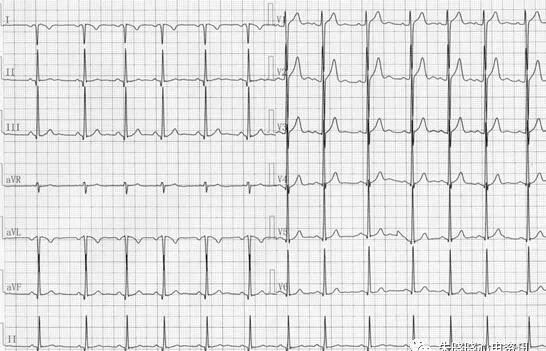 病理性q波心电图形图片
