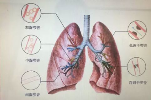 医生必须掌握的肺部听诊技巧 值得收藏 医学界 助力医生临床决策和职业成长