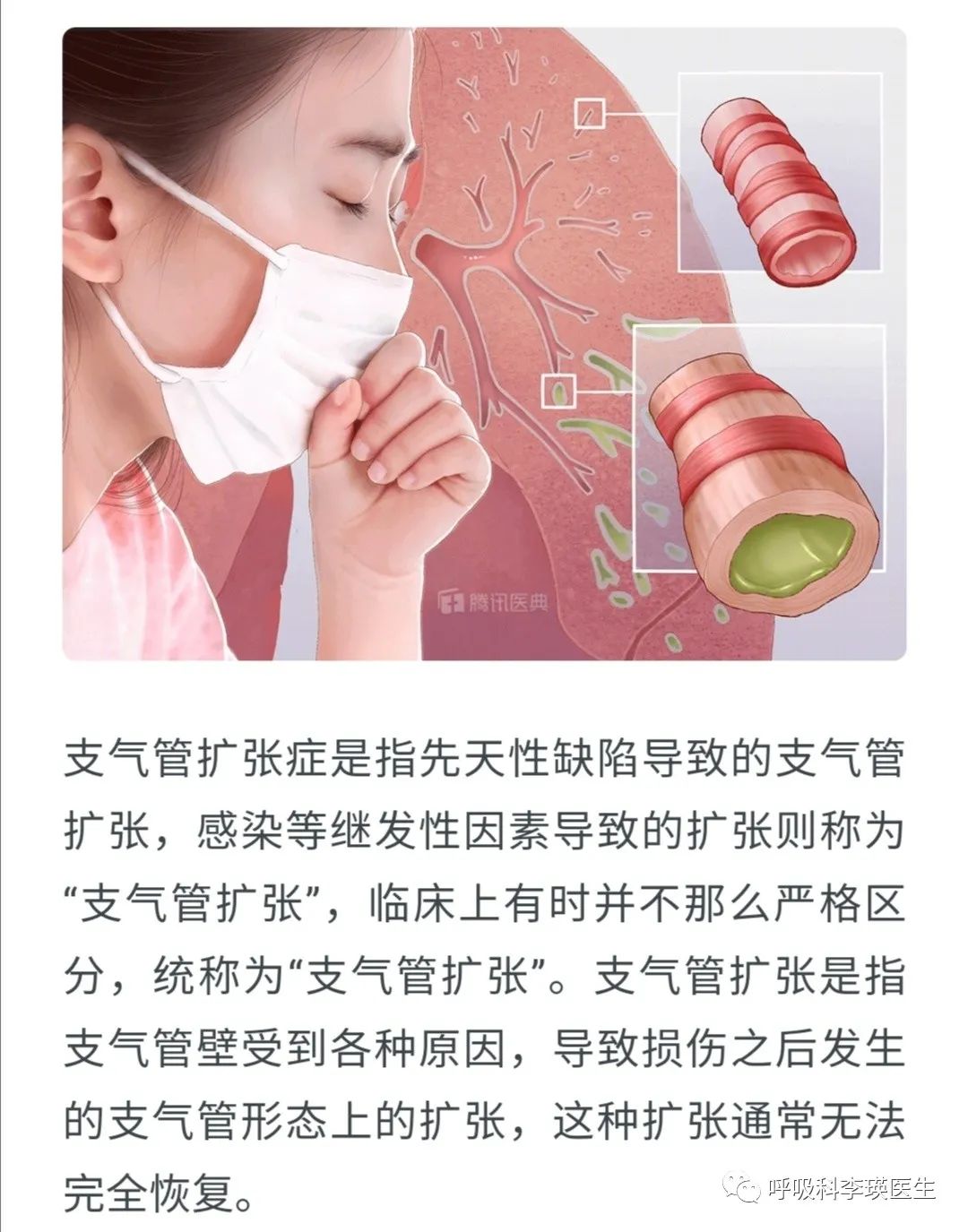 支气管扩张症如何做手术?可以分这两种