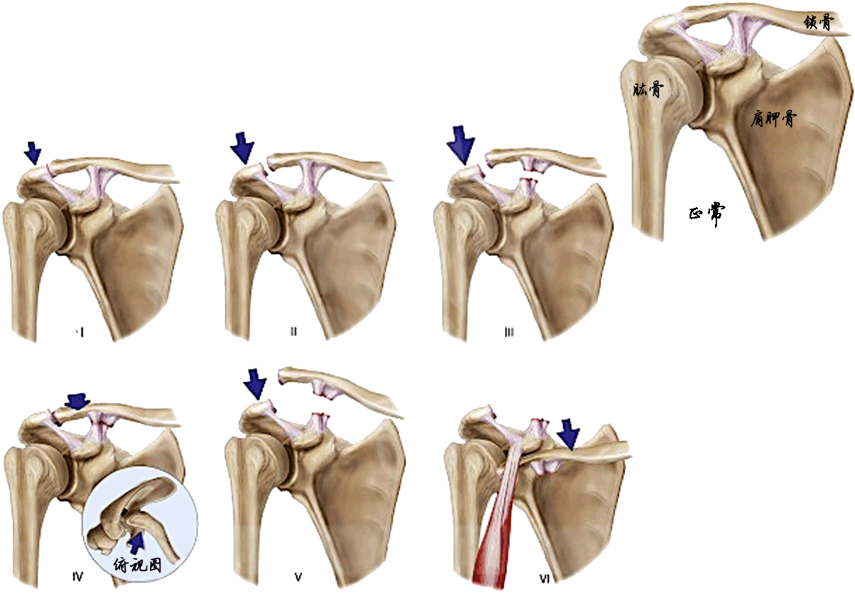 肩关节脱臼图片解剖图图片