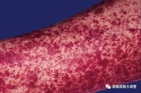 皮质激素等可导致面,胸背部痤疮毛囊炎样皮疹