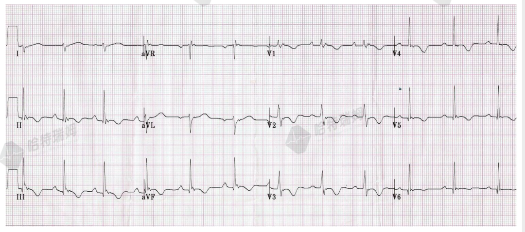心电图可见epsilon波,右胸导联t波倒置;心脏彩超提示左室长轴切面右室