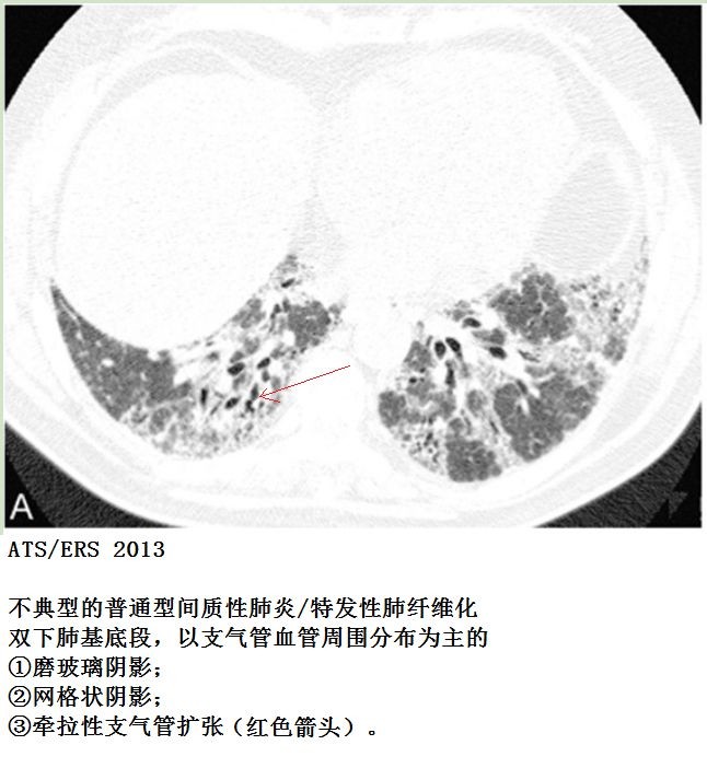间质性肺炎经典图谱 | 经典病例，一看就会