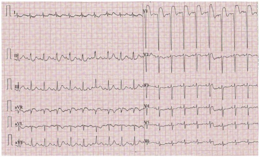avl倒置)和qrs波电轴右偏,胸前导联qrs波振幅进行性降低,提示右位心