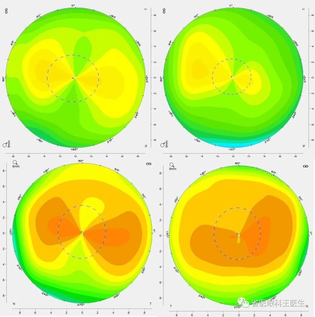 探索假性眼散光之可能出现假性眼散光的9种情况_医学界-助力医生临床