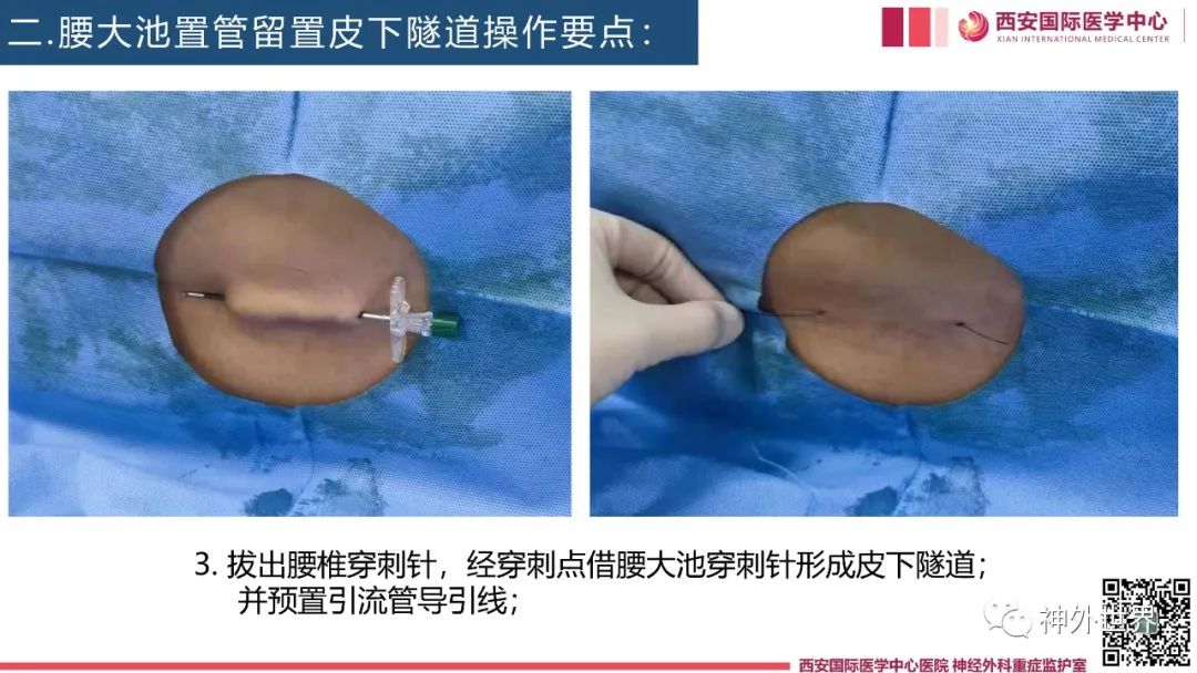 腰大池置管留置皮下隧道技巧分享