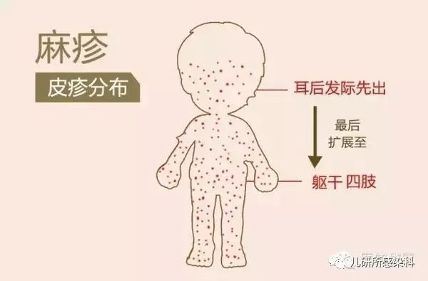 麻疹第四期:麻疹臨床表現_醫學界-助力醫生臨床決策和職業成長