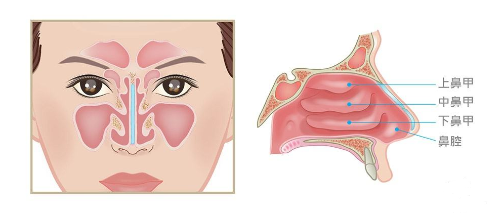 鼻甲肥大是怎么回事?为什么总伴着鼻炎症状?