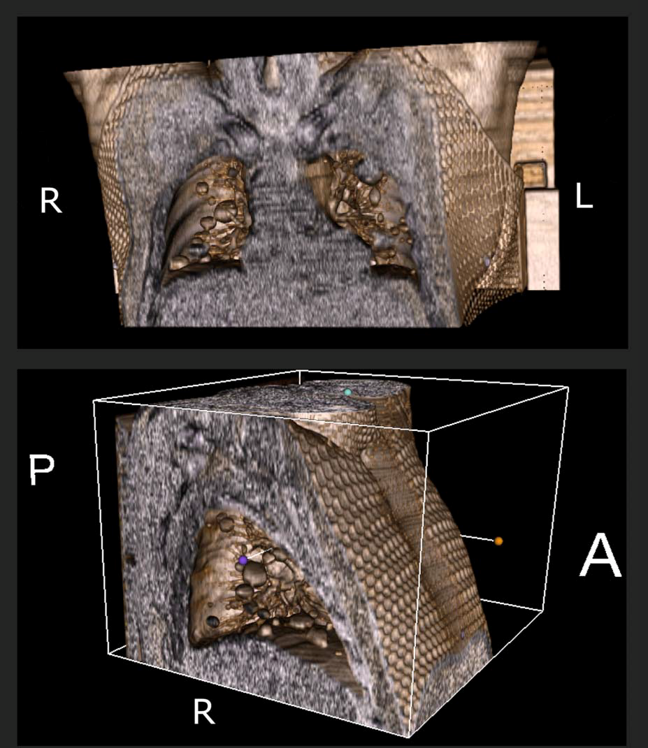 bmj子刊:「炮弹样肺转移瘤」长啥样?