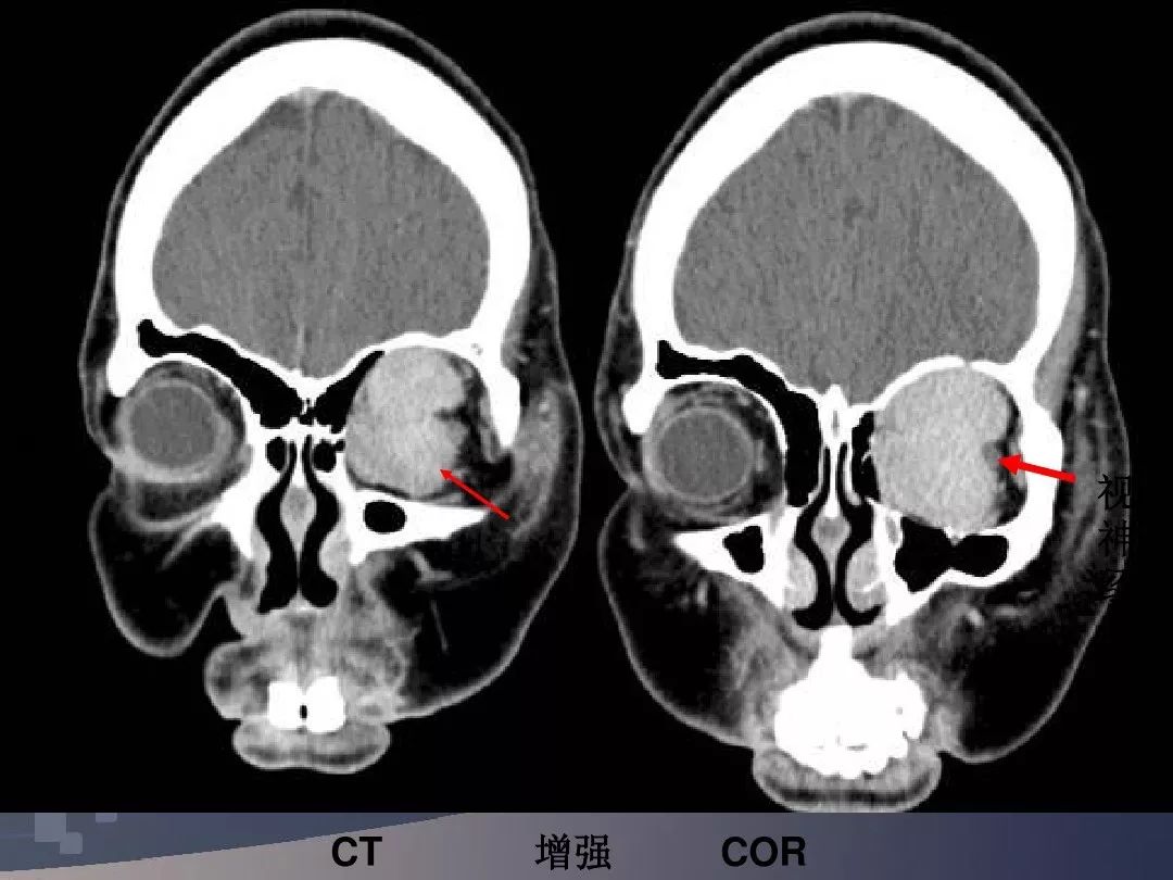 值得收藏:眼睛和眼眶影像解剖图(下)