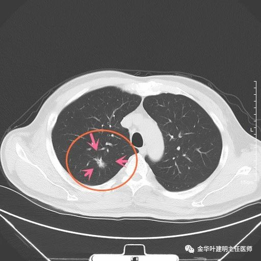 這樣的肺結節不用增強ct,查靶掃描更好_醫學界-助力醫生臨床決策和