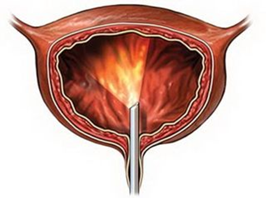 女性膀胱 膀胱镜图片