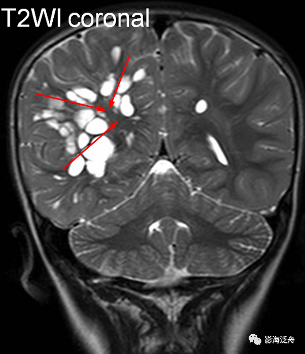 vr腔隙,腔梗灶,微出血,脱髓鞘,傻傻分不清?快看这里!