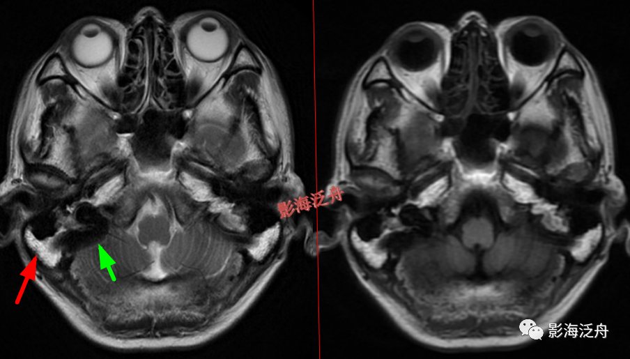 部分患者的乳突窦气化不佳或者邻近颞骨外侧部过厚且黄骨髓较多时