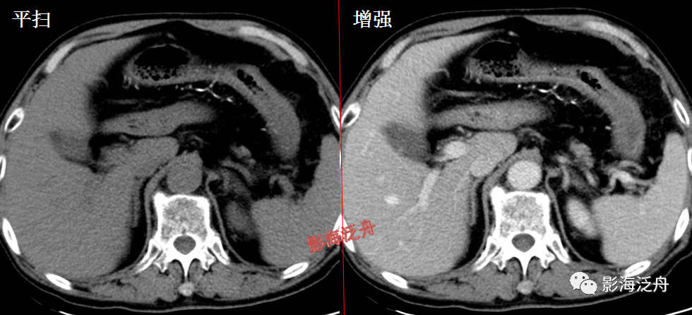 從「腸梗阻」到「結腸癌」,高手是這麼讀片診斷的!