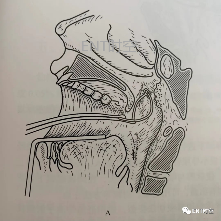 腺样体刮除术,吸切术及等离子融切术