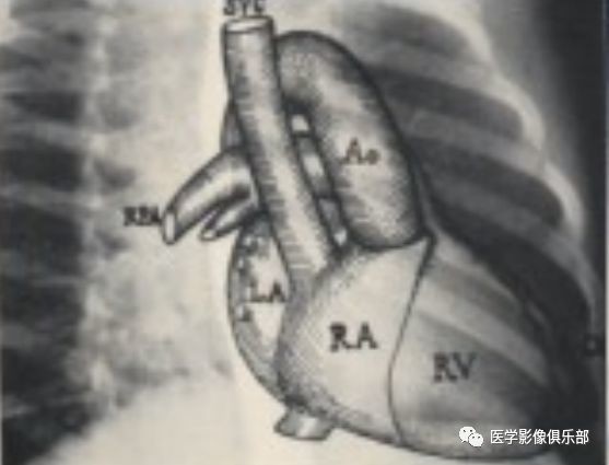 心脏的左前斜位与右前斜位,识别方法看这里_医学界-助力医生临床决策和职业成长