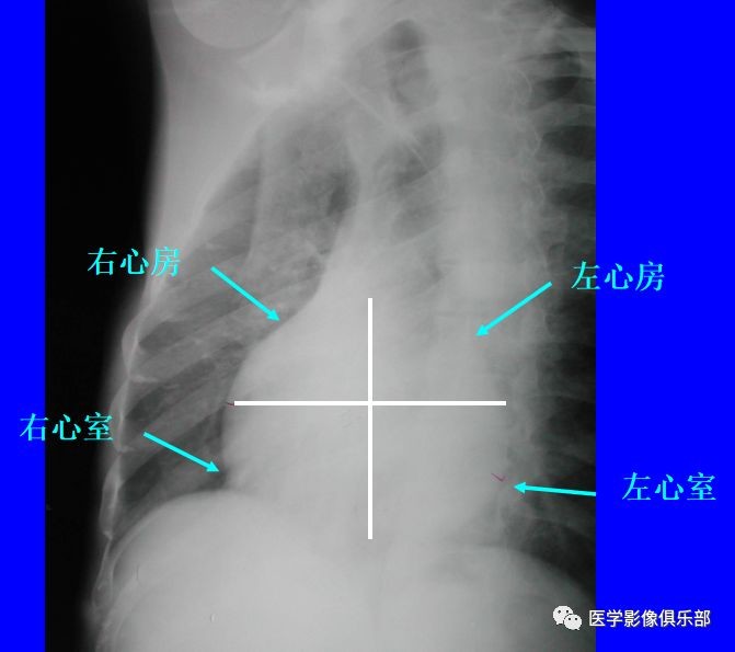 心脏的左前斜位与右前斜位,识别方法看这里_医学界-助力医生临床决策和职业成长