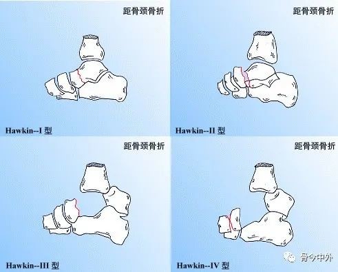 距骨骨折切开复位内固定手术细节 不容错过 医学界 助力医生临床决策和职业成长