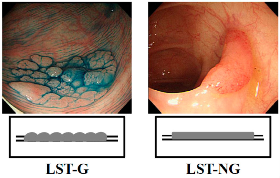 乾貨,最新指南幫你搞定內鏡下切除結直腸病灶_醫學界-助力醫生臨床