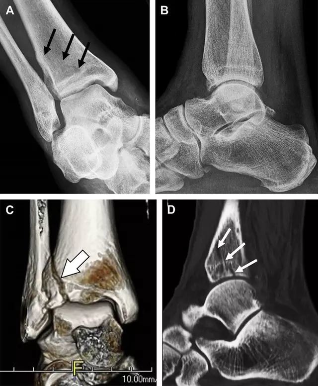 易漏診的 7 種踝部骨折_醫學界-助力醫生臨床決策和職業成長