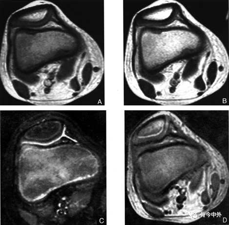 7分钟掌握髌骨软骨软化症的影像诊断与治疗