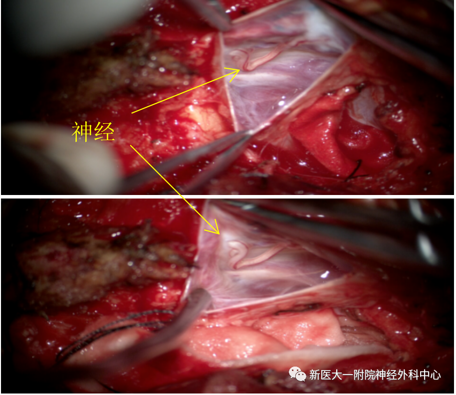 骶管囊肿手术图片