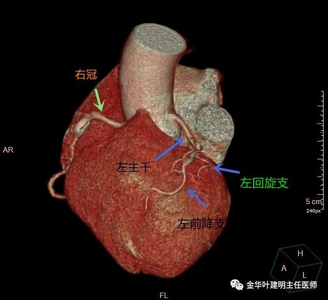 認為需要做冠脈造影,結果還不錯:左主幹無狹窄,前降支的段20%狹窄,右