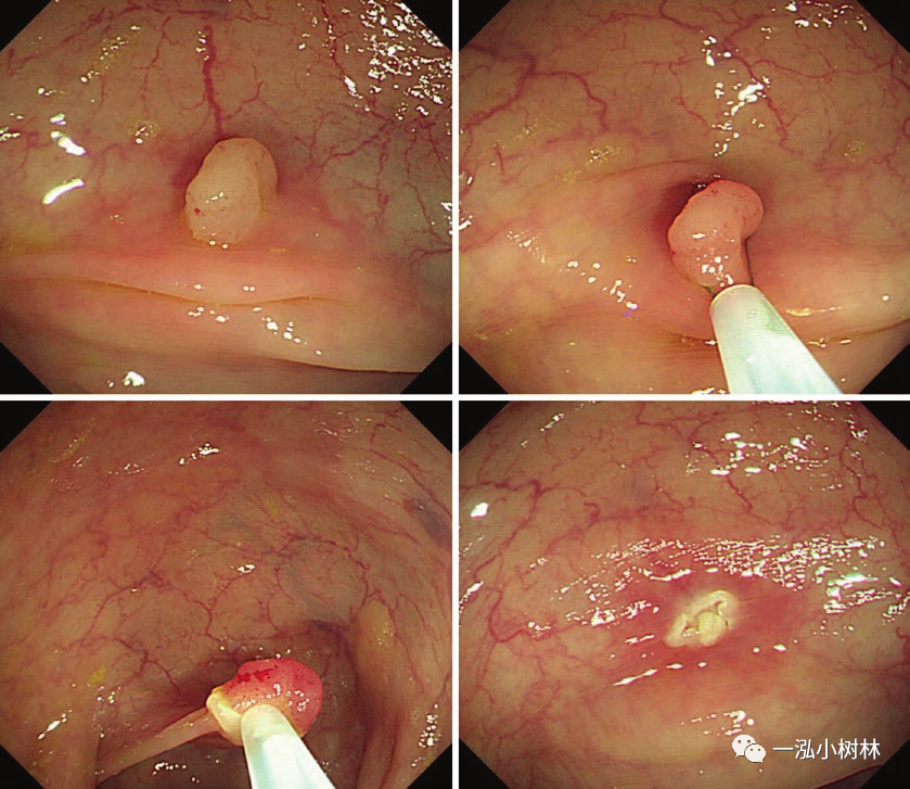 肠息肉切除过程图图片