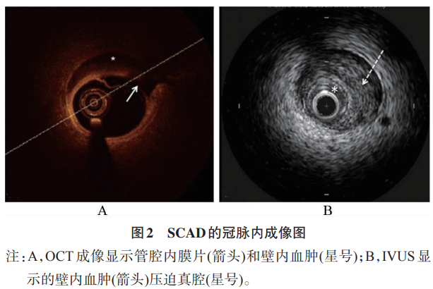自发性冠状动脉夹层：容易被忽视的ACS病因 _医学界-助力医生临床决策和职业成长