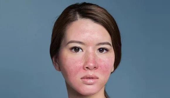 【皮肤病课堂】都是红脸,敏感性肌肤与玫瑰痤疮如何区分_医学界-助力