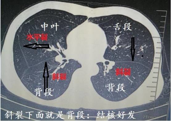 ct诊断肺结核宝典