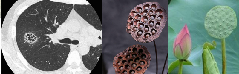 非常有趣的肺ct 莲蓬征 你见过吗 医学界 助力医生临床决策和职业成长