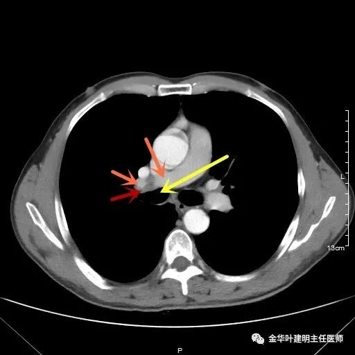 病例分享：1小时完成中央型肺癌右全肺切除术_医学界-助力医生临床决策