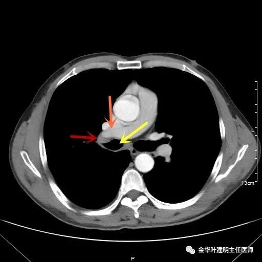 病例分享：1小时完成中央型肺癌右全肺切除术_医学界-助力医生临床决策