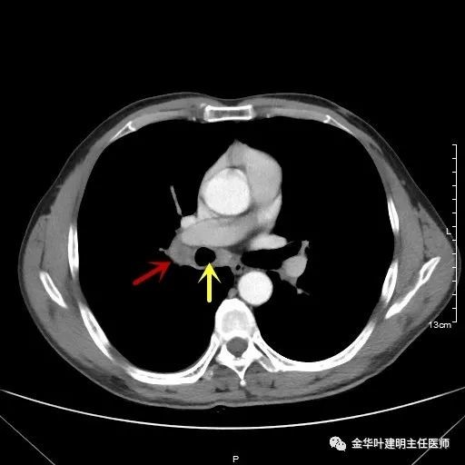 病例分享1小時完成中央型肺癌右全肺切除術